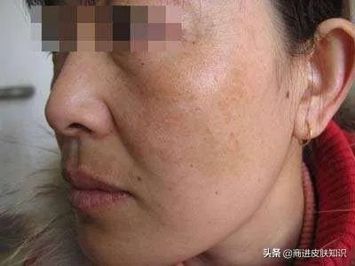 黄褐斑长什么样图片?