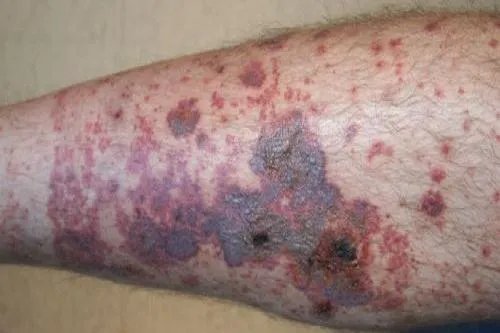 老人皮下出血性紫癜图片