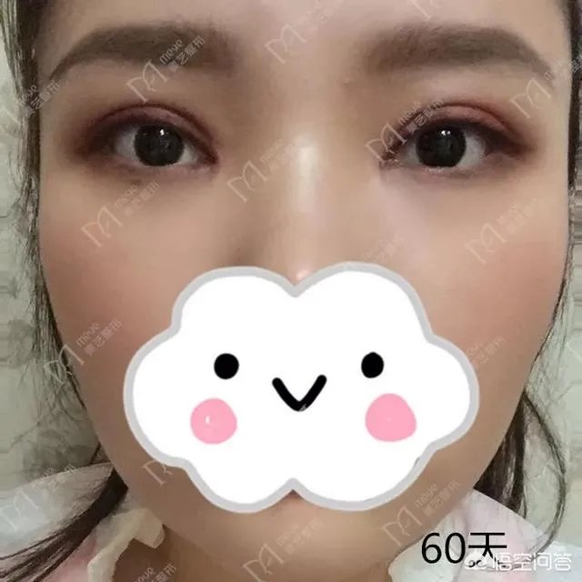 做双眼皮有几种方法?