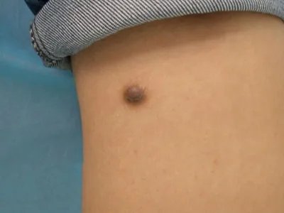 皮肤纤维瘤结节图片