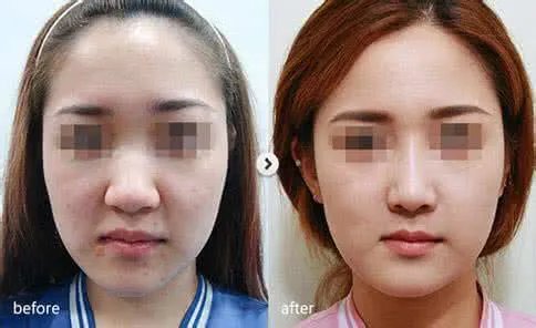 玻尿酸隆鼻多少钱一针呢