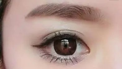 做双眼皮埋线能维持多久