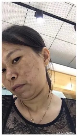 黄褐斑长什么样图片?