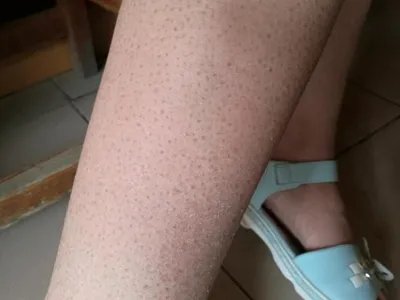 毛发苔藓斑图片