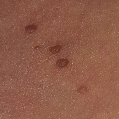 扁平尤是什么原因?