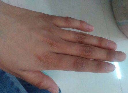 手上皮肤黑粗糙怎么办