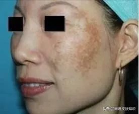 黄褐斑长什么样图片?