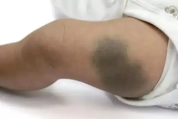 胎记有几种类型图片