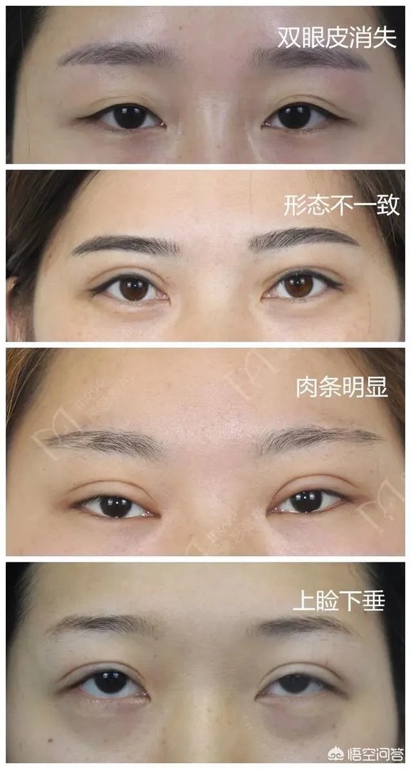 做双眼皮有几种方法?