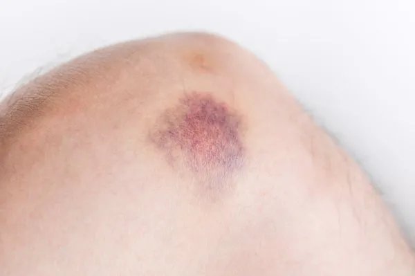 毛细血管环状紫癜原因