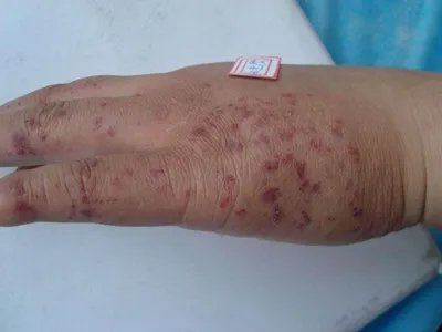 弥漫性躯体性血管角化瘤丘疹图片