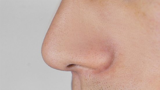 鼻子上长痘痘是什么原因