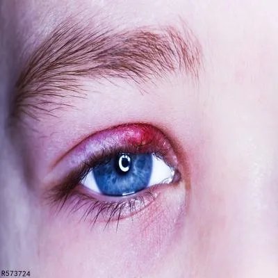 眼睑下垂手术过程中应该注意什么