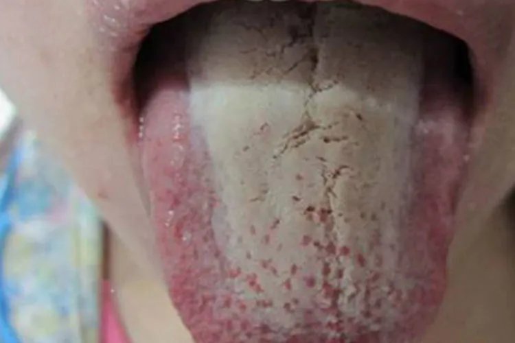 胃癌早期舌头裂纹图片