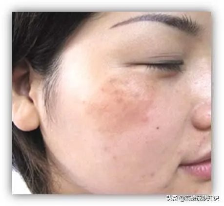 黄褐斑长什么样图片?