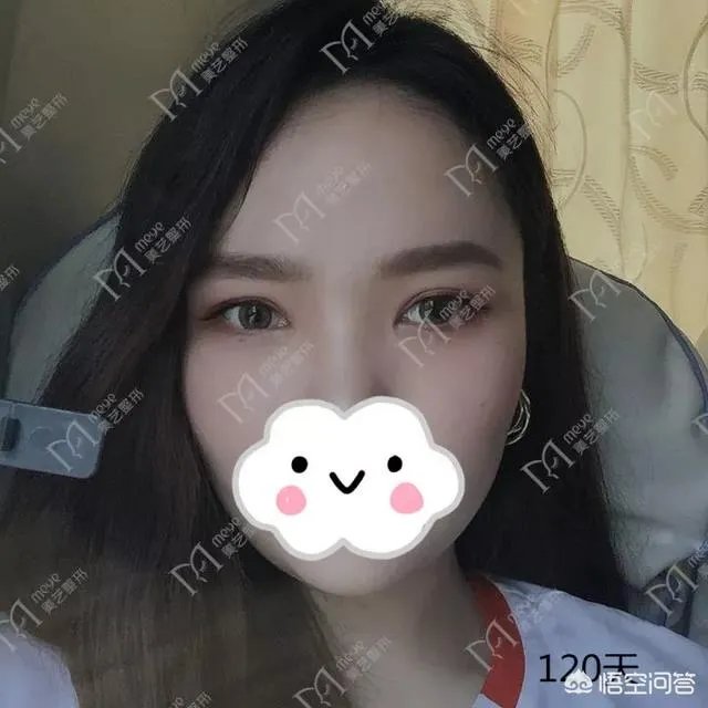 做双眼皮有几种方法?