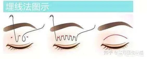 做双眼皮有几种方法?