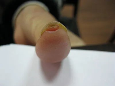 甲下外生骨疣肉球图片