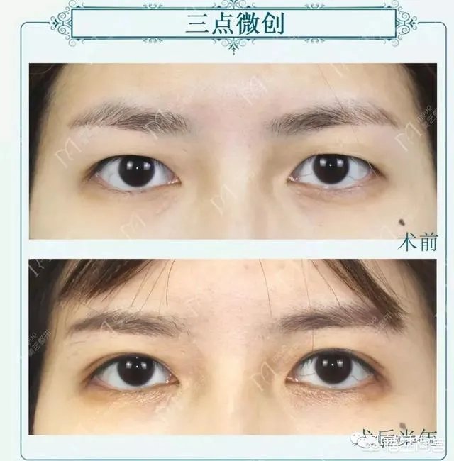 做双眼皮有几种方法?