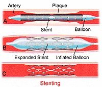在未来，能做全身的血管支架手术吗？