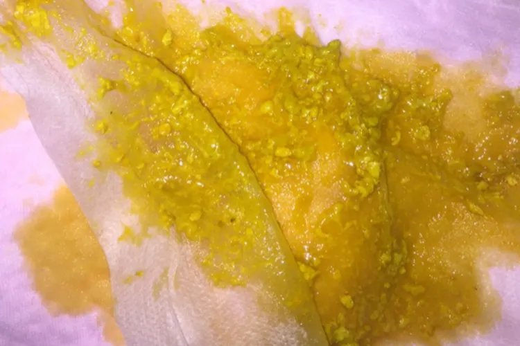 婴儿腹泻大便种类图解