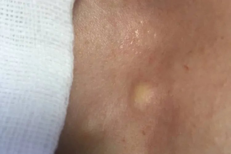 腋窝下疙瘩挤出黄黄的东西图片