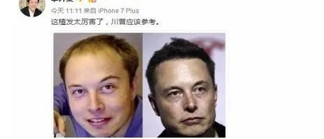 有哪些明星做过植发？