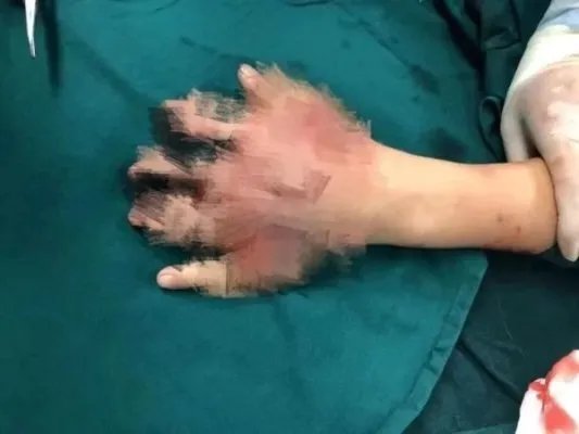 文昌12岁男孩玩鞭炮被炸断5指，目前情况如何？