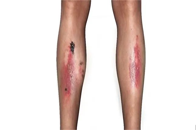 糖尿病真实图片大全