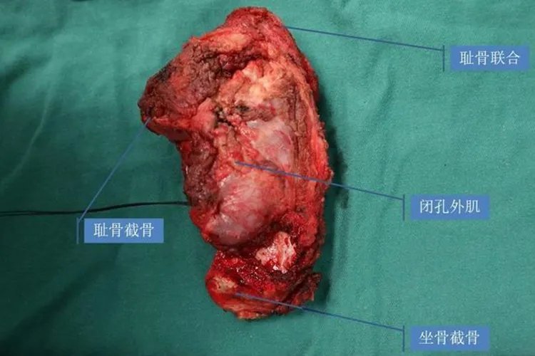 尤文肉瘤真实图片