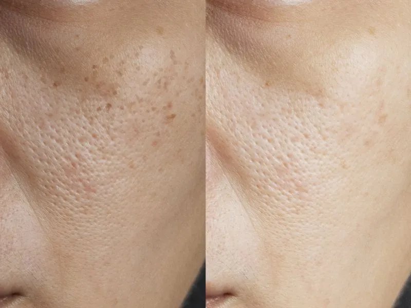 脸上有黄褐斑怎么回事