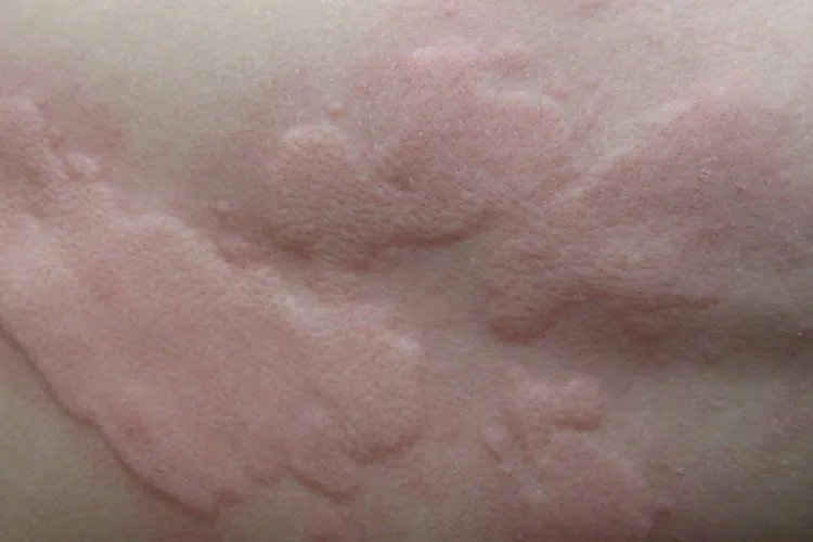 火龙果过敏症状图片大全