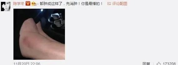 2017维密大秀，超模奚梦瑶不慎摔倒，未来的道路会如何？