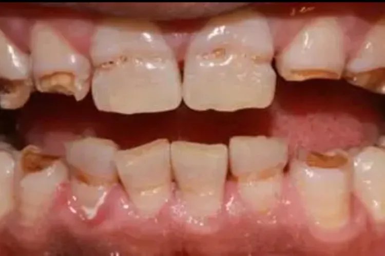 牙齿变黑的原因图片