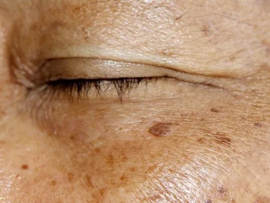 黄褐斑形成的主要因素有哪些