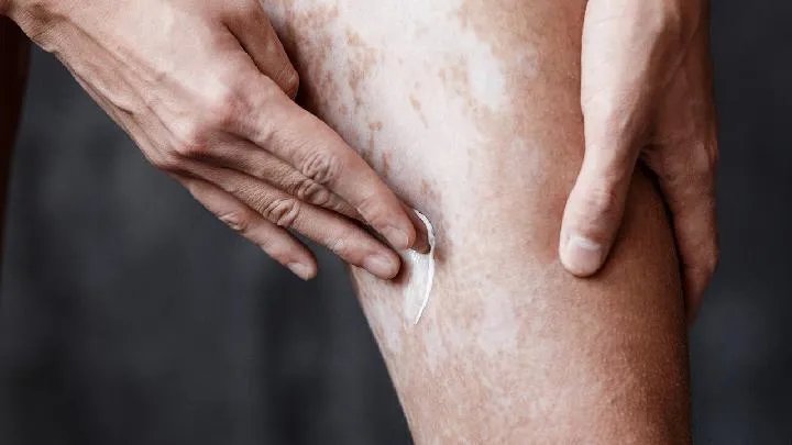 苏州白癜风医院：网购白癜风药品靠谱不