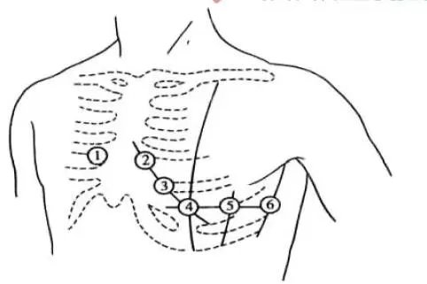 胸导联v1到v6的位置图