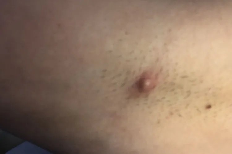 腋窝下疙瘩挤出黄黄的东西图片