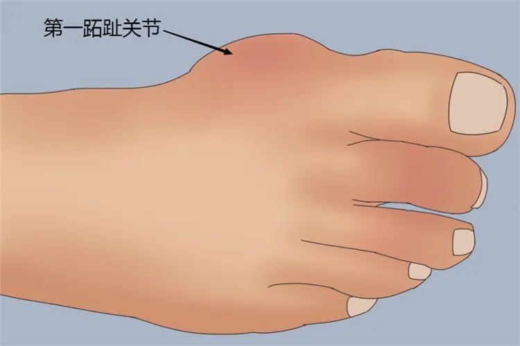 痛风脚趾疼痛的位置图