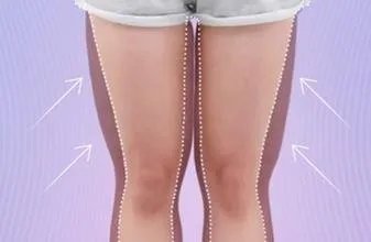 抽脂瘦大腿的价格
