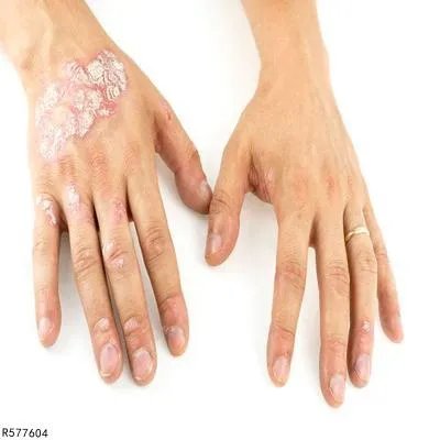 什么药治疗银屑病效果好 治疗银屑病效果好的三种药介绍