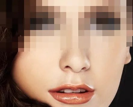 嘉兴假体隆鼻哪家医院比较好?嘉兴假体隆鼻价格一览表