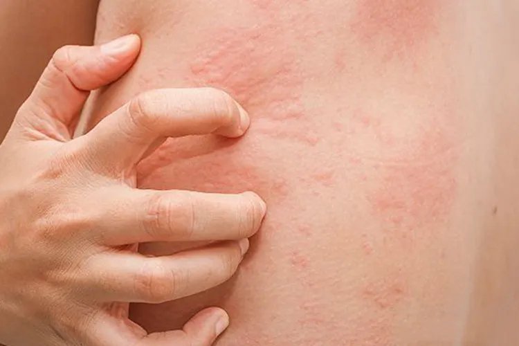 荨麻疹性皮炎症状图片