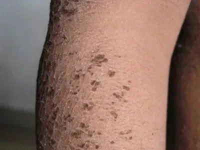 X连锁鱼鳞病胳膊脱屑图片