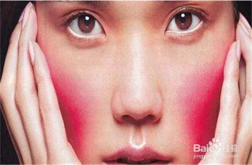 脸上的红血丝怎样处理