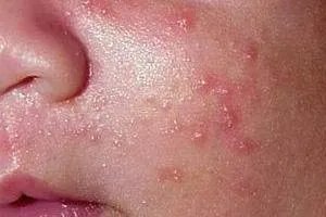 新生儿脸上长红疹子有白头图片