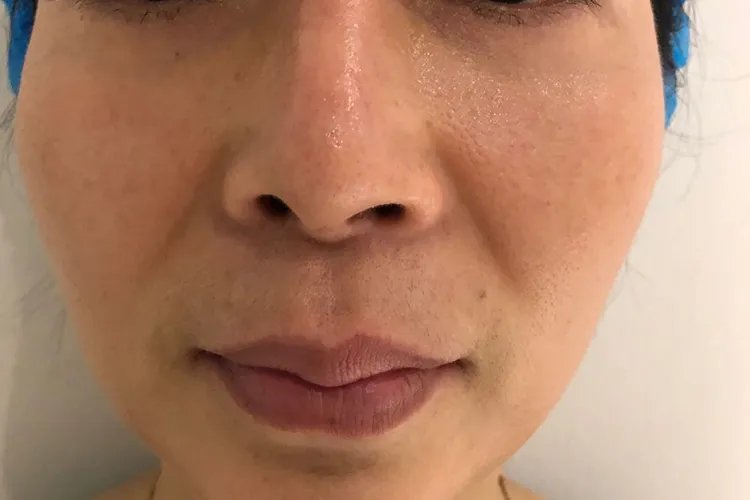 隆鼻后增生的症状图片