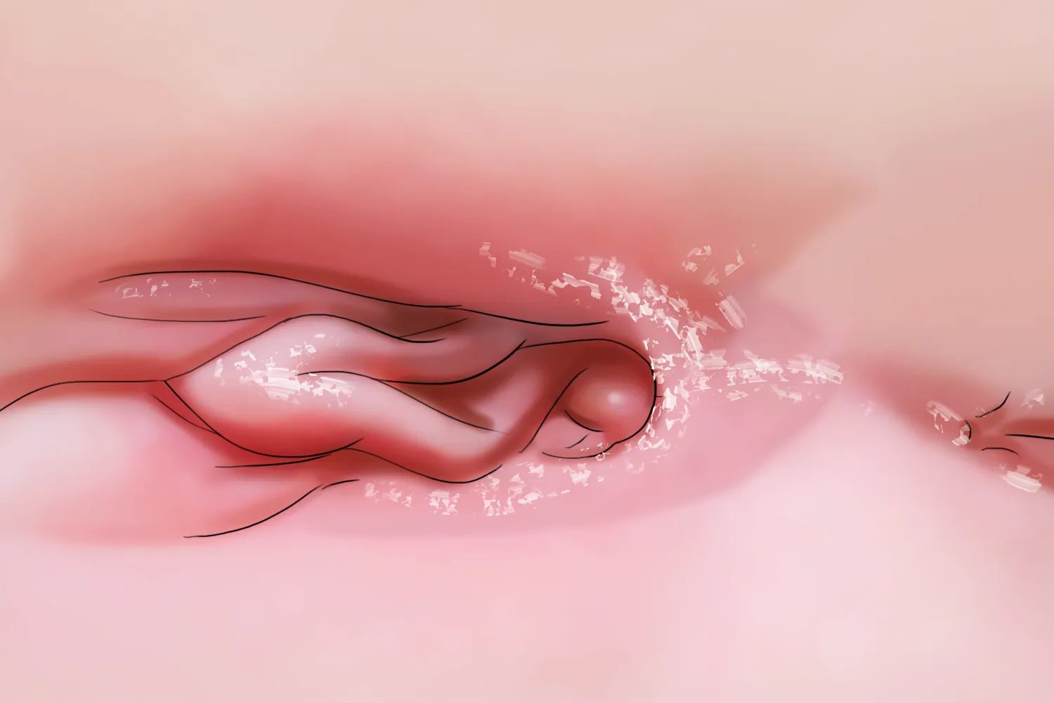 念珠菌病症状图片