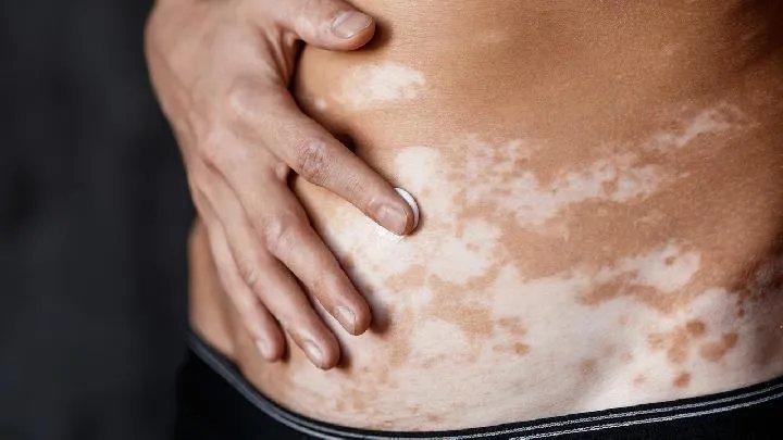 苏州白癜风医院:网购白癜风药品靠谱不