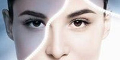 激光祛斑效果如何呢